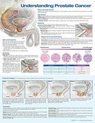 Understanding Prostate Cancer Anatomical Chart (en Inglés)