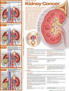 Understanding Kidney Cancer Anatomical Chart (en Inglés)