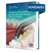 Cementación adhesiva en dientes naturales