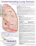 Understanding Lung Cancer Anatomical Chart (en Inglés)