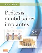 Prótesis Dental Sobre Implantes