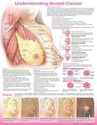 Understanding Breast Cancer Anatomical Chart (en Inglés)