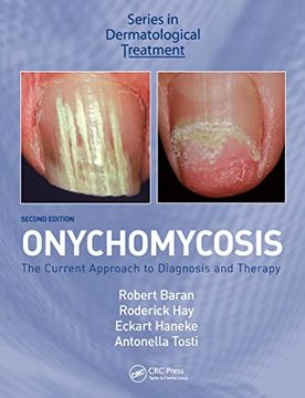portada Onychomycosis (en Inglés)