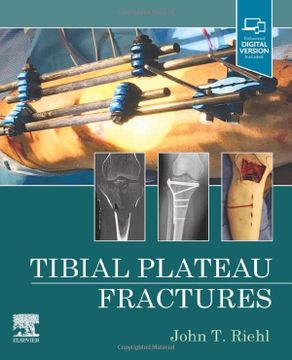 portada Tibial Plateau Fractures (en Inglés)