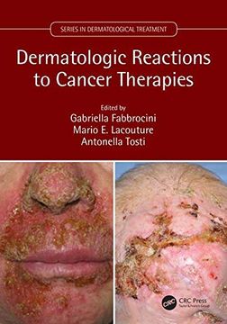 portada Dermatologic Reactions to Cancer Therapies (en Inglés)