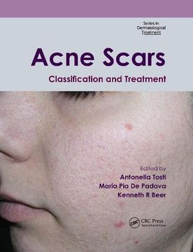 portada Acne Scars: Classification and Treatment (Series in Dermatological Treatment) (en Inglés)