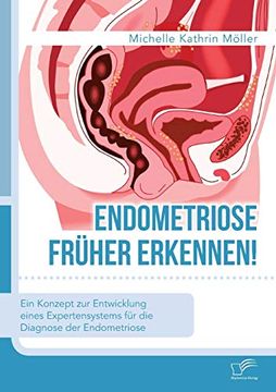 portada Endometriose Frher Erkennen ein Konzept zur Entwicklung Eines Expertensystems fr die Diagnose der Endometriose (en Alemán)
