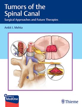 Tumors of the Spinal Canal: Surgical Approaches and Future Therapies (en Inglés)