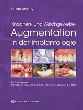 portada Knochen- und Weichgewebeaugmentation in der Implantologie (en Alemán)