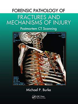 portada Forensic Pathology of Fractures and Mechanisms of Injury: Postmortem ct Scanning (en Inglés)