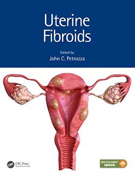 portada Uterine Fibroids (Reproductive Medicine and Assisted Reproductive Techniques s) (en Inglés)