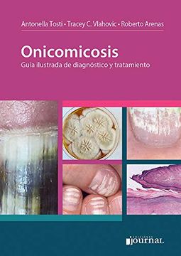 portada Onicomicosis (in Spanish)
