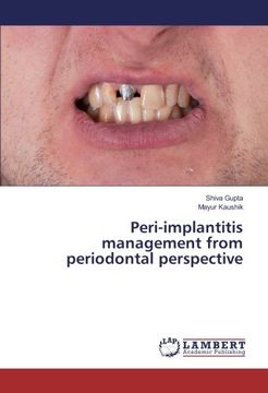 portada Peri-implantitis management from periodontal perspective