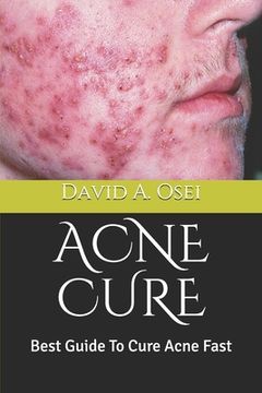 portada Acne Cure: Best Guide To Cure Acne Fast (en Inglés)