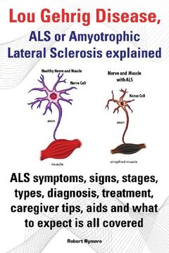 portada Lou Gehrig Disease, ALS or Amyotrophic Lateral Sclerosis Explained. ALS Symptoms, Signs, Stages, Types, Diagnosis, Treatment, Caregiver Tips, AIDS and (en Inglés)
