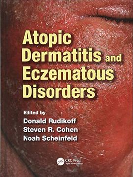 portada Atopic Dermatitis and Eczematous Disorders
