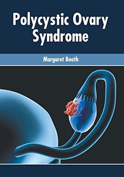 portada Polycystic Ovary Syndrome (en Inglés)