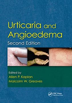 portada Urticaria and Angioedema (en Inglés)