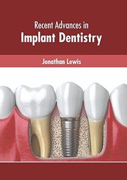 portada Recent Advances in Implant Dentistry (en Inglés)