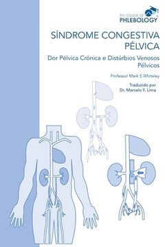 portada Síndrome Congestiva Pélvica dor Pélvica Crônica e Distúrbios Venosos Pélvicos (en Portugués)