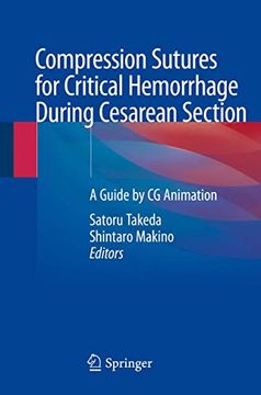 portada Compression Sutures for Critical Hemorrhage During Cesarean Section: A Guide by CG Animation (in English)