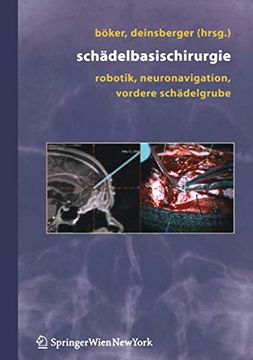portada Schädelbasischirurgie: Robotik, Neuronavigation, Vordere Schädelgrube (in German)