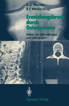 portada Ermüdungsbruch Durch Osteoporose: Risiken von Zyklusstörungen und Leistungssport (en Alemán)