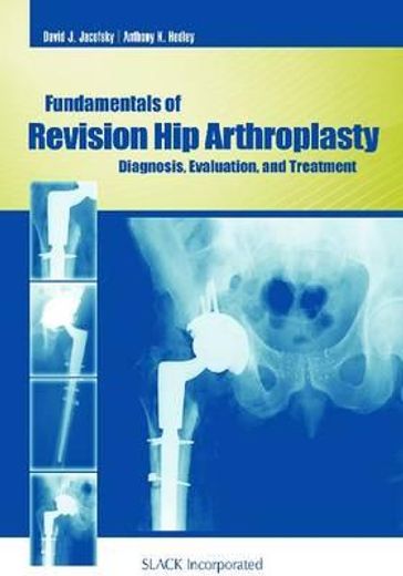 fundamentals of revision hip arthroplasty,diagnosis, evaluation, and treatment