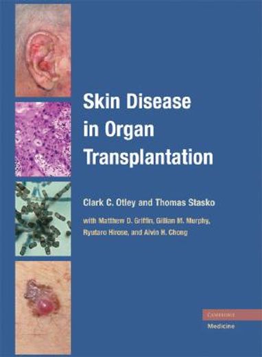 skin disease in organ transplantation