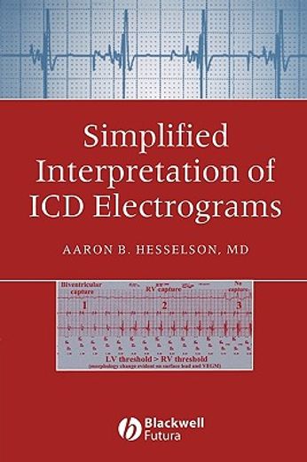 simplified interpretation of icd electrograms