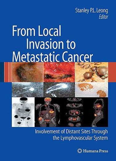 From Local Invasion to Metastatic Cancer: Involvement of Distant Sites Through the Lymphovascular System (en Inglés)
