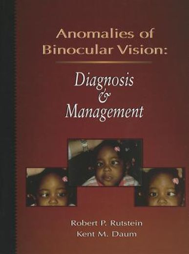 anomalies of binocular vision,diagnosis & management