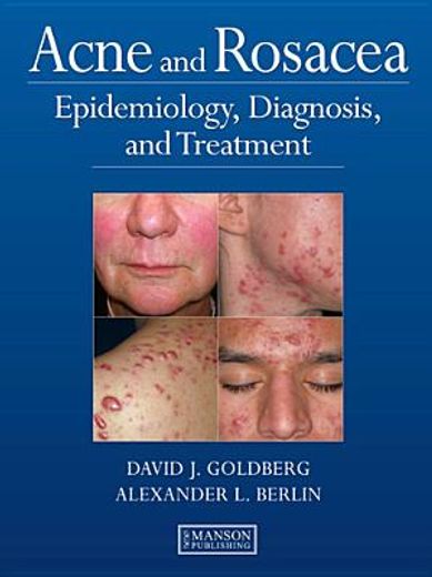 Acne and Rosacea: Epidemiology, Diagnosis and Treatment (in English)